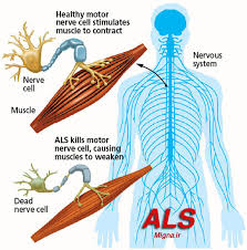 بیماری ALS